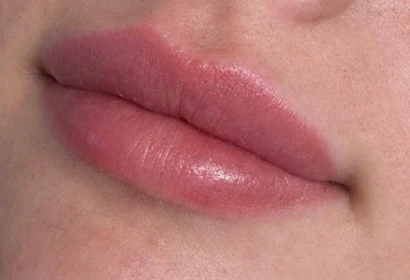 Lip fillers: before and after , after